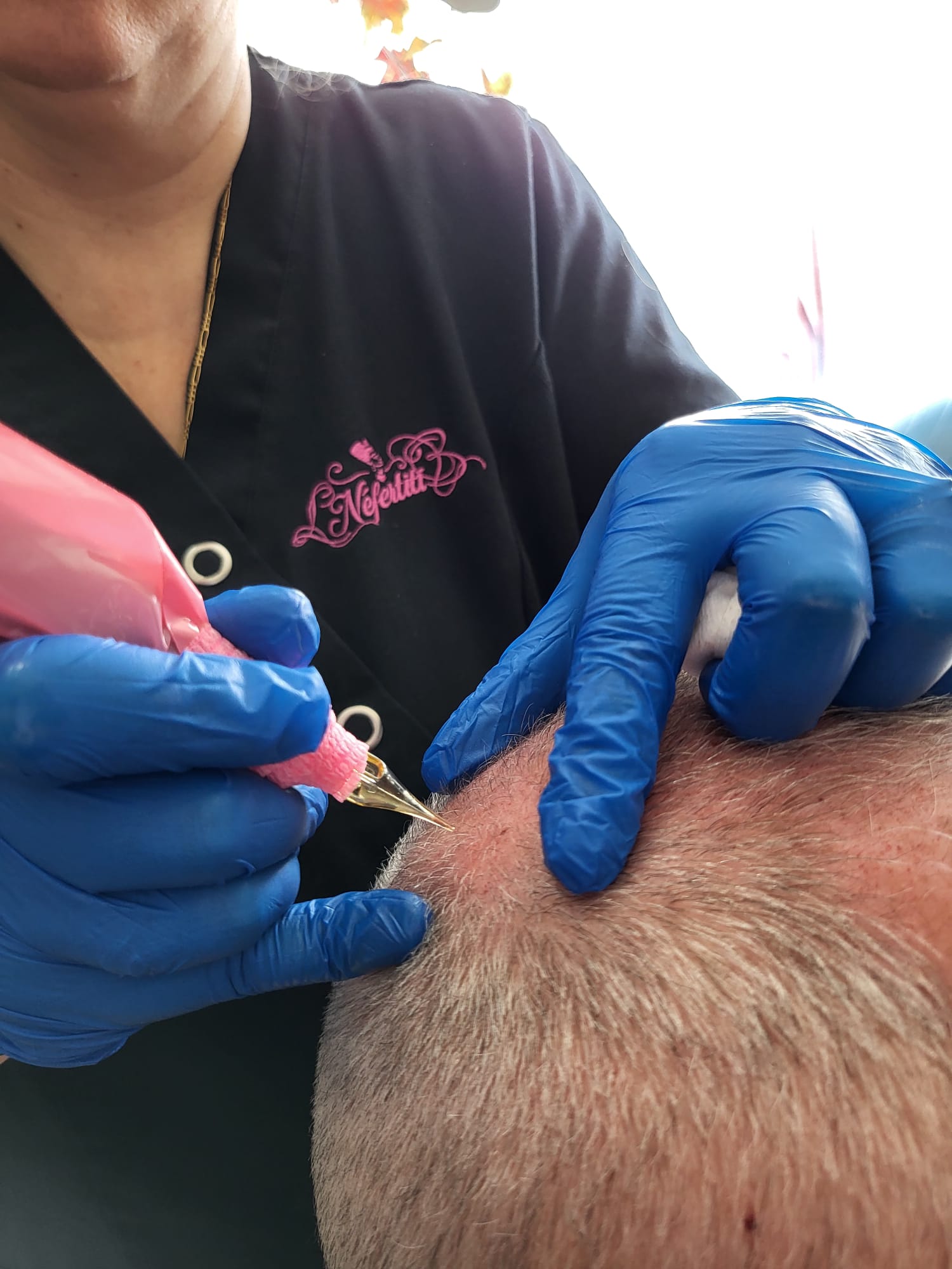 Voir les photos : RECONSTRUCTION POILS, VERGETURES, CICATRICES